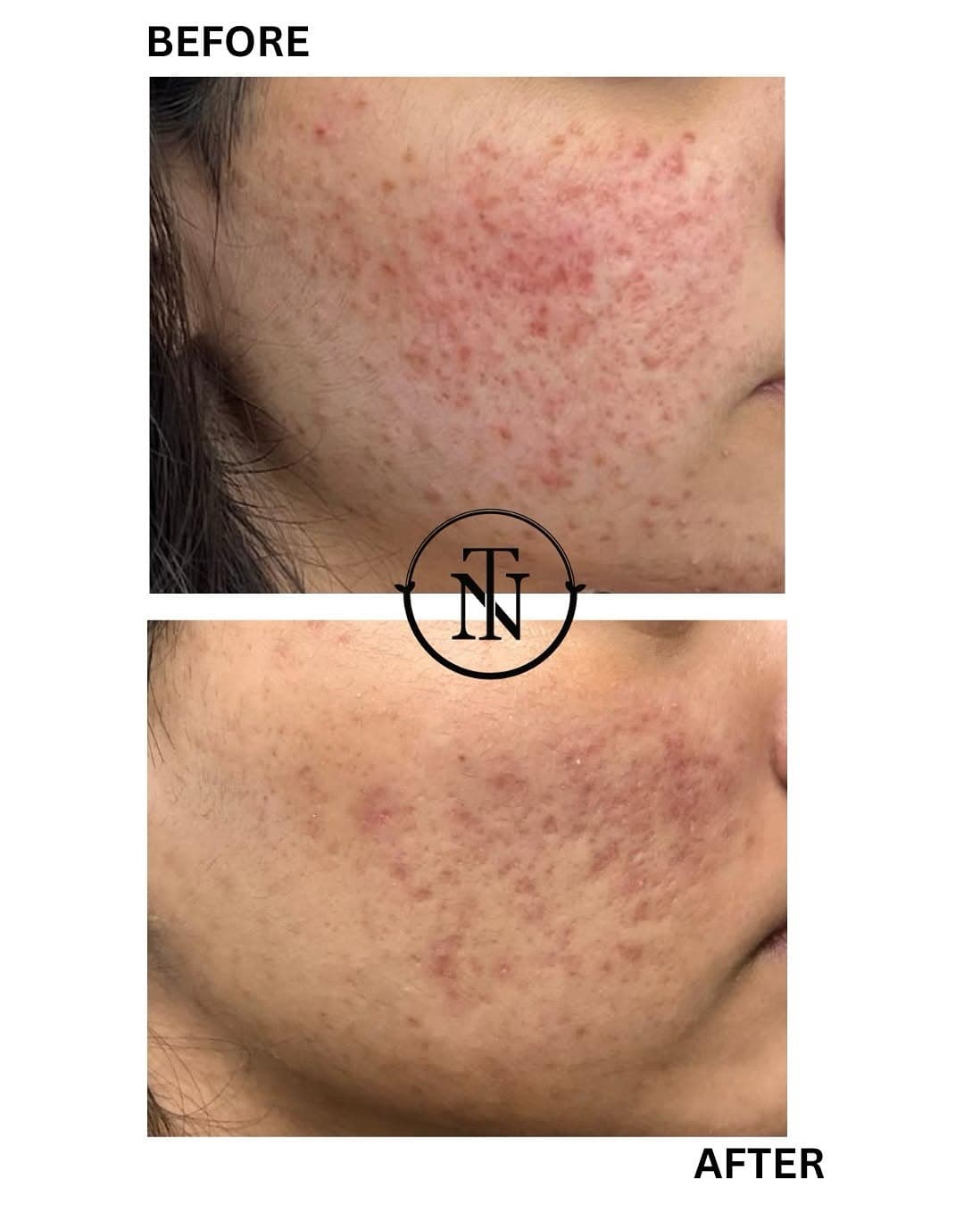 Skin Rejuvenation