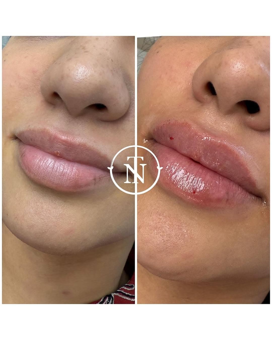 Laser Treatment