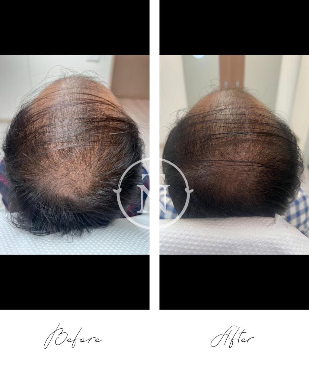 Anti-Aging Results