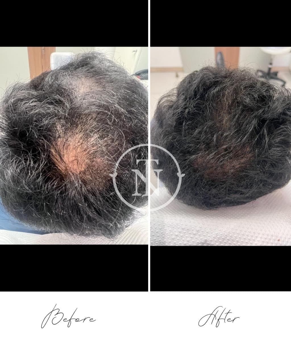 Skin Tightening