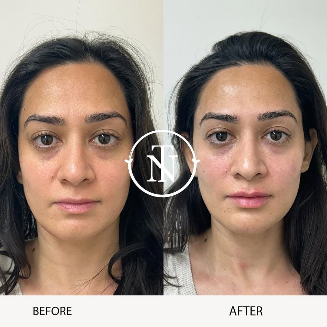 HydraFacial Results
