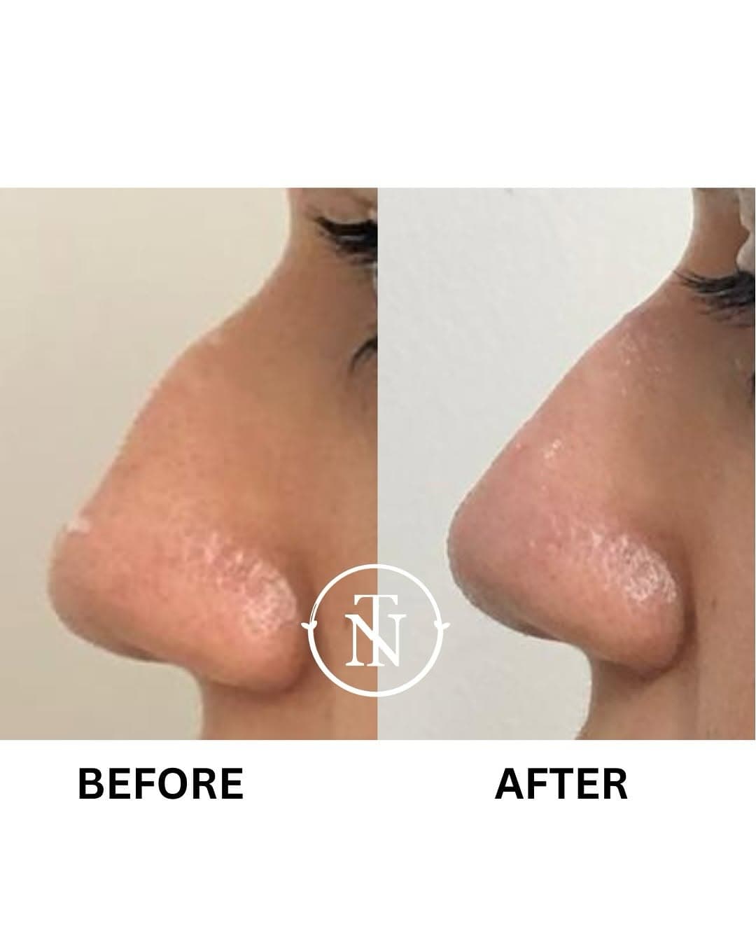 Chemical Peel